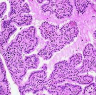 ### Hyperplasia - *Hyperthyroidism*