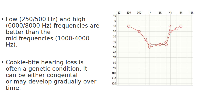 <p>“Moderate cookie-bite hearing loss between 1000 Hz - 5000 Hz”</p>