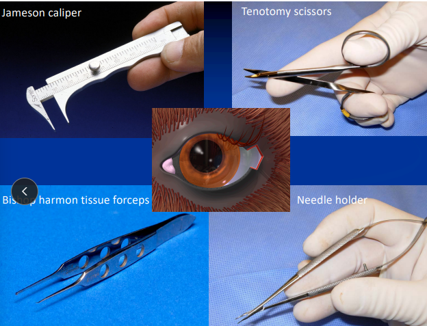 <ul><li><p><span style="color: red;">Long eye lids</span></p></li><li><p><span style="background-color: transparent;"><strong><span>Et: </span></strong><span>Abnormally large eyelid opening (palpebral fissure).</span></span></p></li><li><p><span style="background-color: transparent;"><strong><span>Cs:</span></strong></span><span style="background-color: transparent; color: red;"><strong><span> cause of nearly all entropion and ectropion cases</span></strong></span></p></li><li><p><span style="background-color: transparent;"><strong><span>Dt: </span></strong><span>maximum canthus-to-canthi distance measurement </span><strong><span>under GA </span></strong></span></p><ul><li><p><span style="background-color: transparent;"><span>Normal = </span></span><span style="background-color: transparent; color: red;"><span>24-26 mm</span></span></p></li></ul></li><li><p><span style="background-color: transparent;"><strong><span>Tx: </span></strong><span>Permanent Lateral Canthoplasty</span></span></p><ul><li><p><span style="background-color: transparent; color: rgb(176, 176, 176);"><span>surgical shortening improves corneal protection</span></span></p><ul><li><p><span style="background-color: transparent; color: rgb(2, 1, 1);"><span>Look where the canthus collapses & notching at the fold</span></span><span style="background-color: transparent; color: rgb(176, 176, 176);"><span> .</span></span></p></li></ul></li><li><p><span style="background-color: transparent; color: rgb(176, 176, 176);"><strong><span>Ends should be tucked away from the cornea.</span></strong></span></p><ul><li><p>Double layer closure, second layer cruciate </p></li></ul></li></ul></li></ul><p></p>