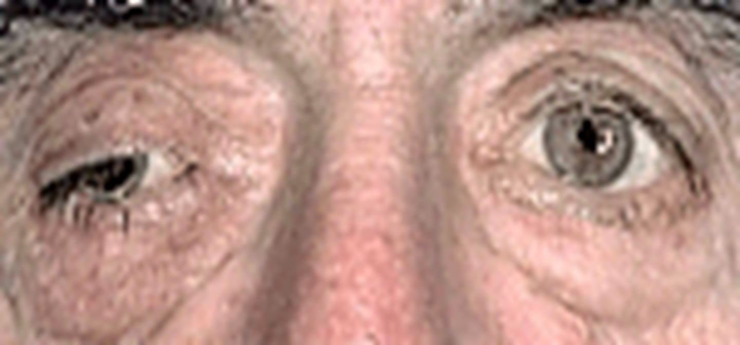 <p>ask about pain/diplopia</p><p>indirect APD test to confirm no afferent problem with CN II</p><p>eyelid function to confirm no ptosis</p><p>EOM to confirm no palsy</p><p>screen other CN</p><p>pharmacolgoical supersensitivity test would NOT be okay to do</p>