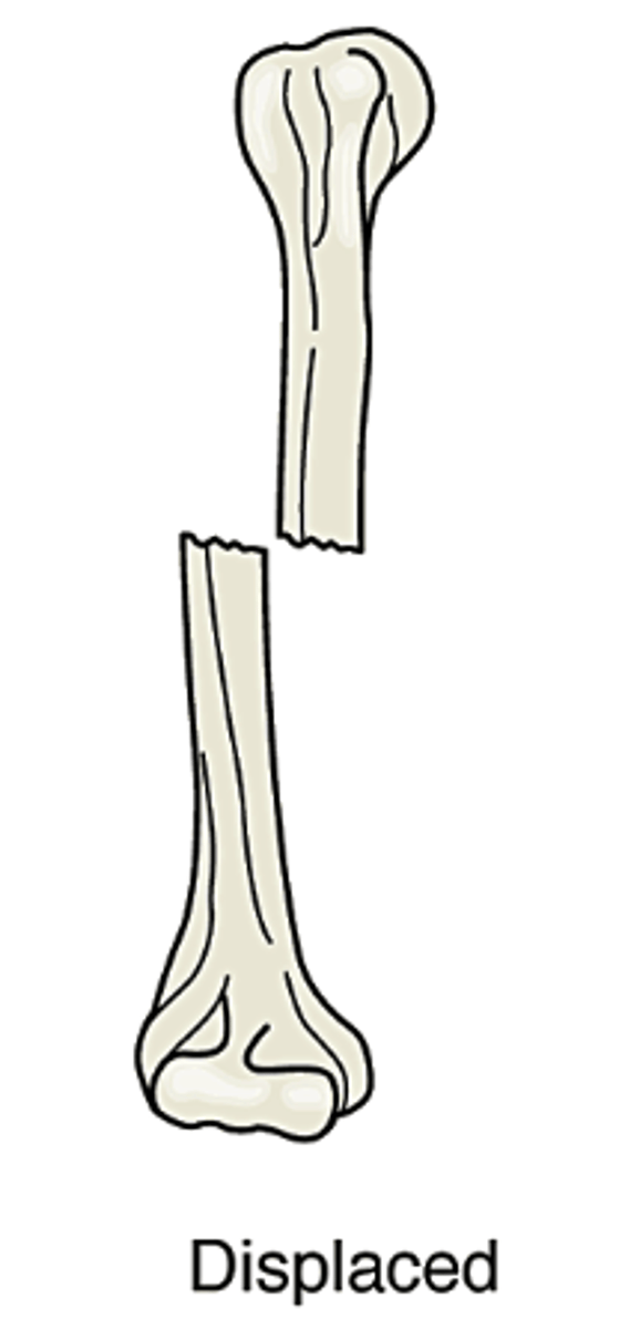 <p>Bone pieces are out of normal alignment. One or more pieces may be out of alignment</p>
