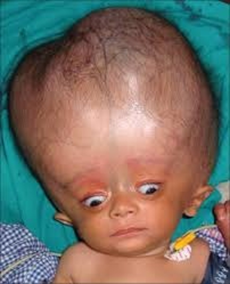 <p>____ is an abnormal increase in the volume of the cerebrospinal fluid within the skull.</p>