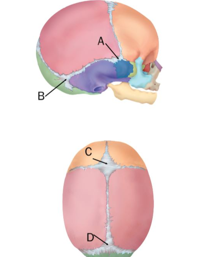 Identify the four prominent fontanels in the figure of the newborn skull.