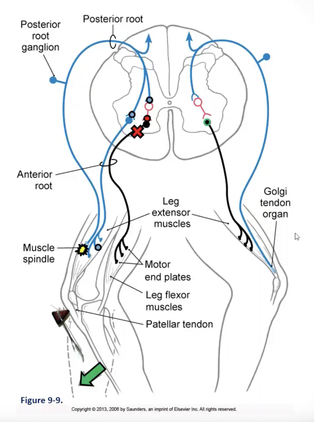 <p><strong><u>autogenic inhibition:</u></strong> sensory response to muscle tension (aka: GTO reflex arc)</p><ul><li><p><strong><u>circuit:</u></strong> afferent limb: GTO (golgi tendon organs) afferents; efferent limb: alpha-motor neurons</p><ul><li><p><u>golgi tendon organ afferents:</u> excite an inhibitory interneuron that then inhibits the alpha motor neurons in the ventral horn of the SC that innervate the same muscle that was producing the tension (<em>feedforward inhibition)</em>= reduced contraction of the agonist</p></li><li><p><u>reciprocal excitation:</u> via local circuit neurons excitatory connections<em> (feedforward excitation)</em> are made with the alpha motor neuron of the antagonist muscle= increased contraction of the antagonist</p></li></ul></li><li><p><strong><u>function:</u></strong> plays a major role in protective responses to inappropriate levels of muscle tension and spreads the work of force generation equally across motor units/other muscle fibers to ensure efficient generation of force (i.e. protect a muscle against excessive amounts of force that would damage it); works with MS reflex to ensure coordination of agonist and antagonist muscle activity in response to changing conditions</p><ul><li><p>e.g. a weight-lifter straining to lift a heavy load; autogenic inhibition reflex results in a muscle losing its power, causing the weight to come crashing down to the ground </p></li></ul></li></ul><p><strong><u>image (right side)</u></strong></p><ul><li><p>alpha motor neuron fires away, increasing tension</p></li><li><p>in response to changes in muscle tension, there is discharge of the golgi tendon organ</p><ul><li><p>as muscle tension increases, the golgi tendon organ will increase its firing rate</p></li></ul></li><li><p>sensory information continues to come in and enter the spinal cord</p></li><li><p>feed-forward inhibition- activates inhibitory interneuron that will suppress the activity of the alpha motor neuron (i.e. inhibitory interneuron will inhibit/reduce the firing rate of the alpha motor neuron)</p><ul><li><p>a way to shut down activity in an overactive muscle</p></li></ul></li></ul><p></p>