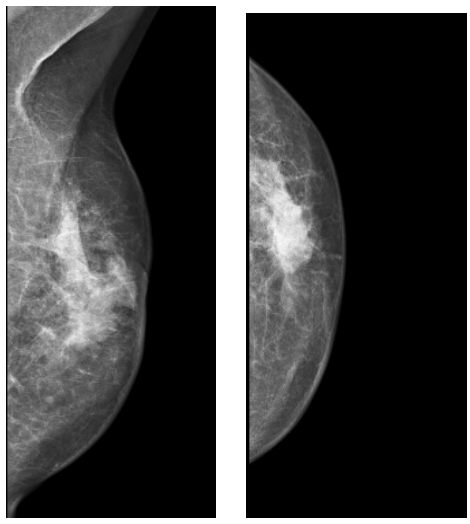 <p>What is shown in this Mammography image?</p>