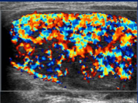 <p>This “thyroid inferno” appearance is most characteristic of:</p>