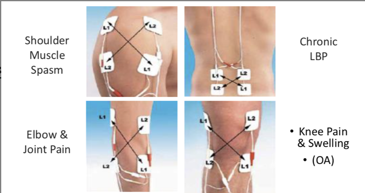 <p>IFT Electrodes &amp; Area of Stimulation</p>
