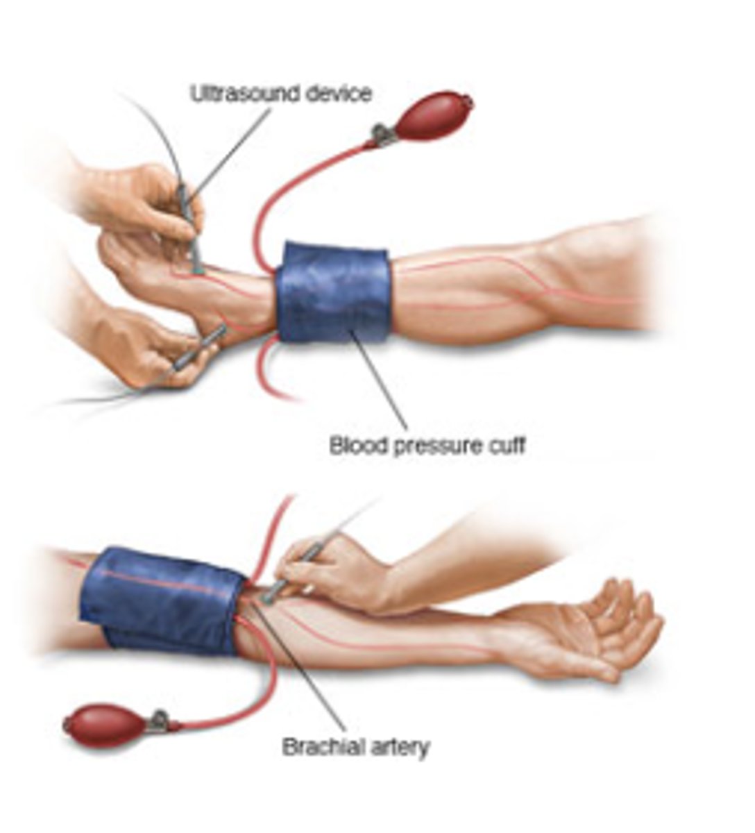 <p>Quick non-invasive procedure that compares BP in ankle w/ BP in arm — used to dx Peripheral Arterial Disease (PAD)</p>