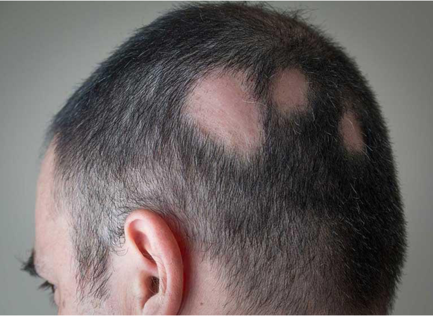 <p>Alopecia</p>