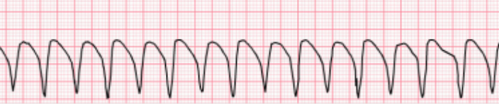 <p>Determine the ventricular dysrhythmia:</p><ul><li><p>Ventricular rate is faster than 100 bpm</p></li><li><p>can be monomorphic or polymorphic </p></li><li><p>can be pulseless or with pulse</p></li></ul><p></p>