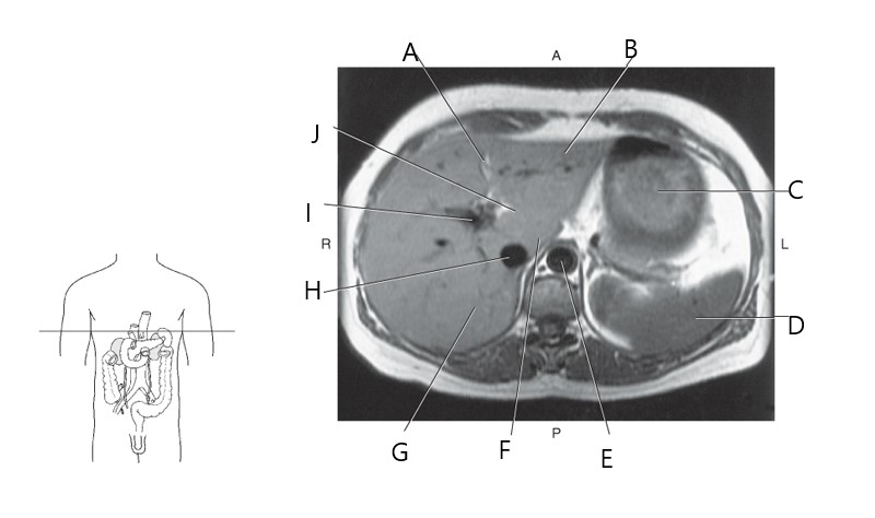 <p>Falciform ligament</p>