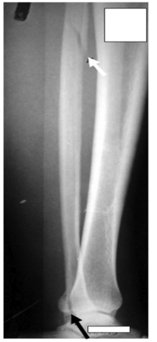 <p>- Fracture at the medial malleolus with a fracture of the proximal fibula.</p><p>- It is important to ensure that all of the anatomy is included in the image so that both fractures can be viewed.</p><p>- If the patient's ankle joint is painful, ask the patient if they also have pain at the top of the fibula. This could mean that they have a possible maisonneuve fracture.</p>