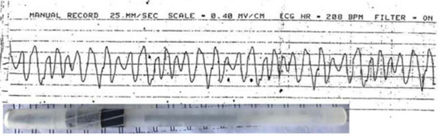 <p>What is the arrhythmia?</p>