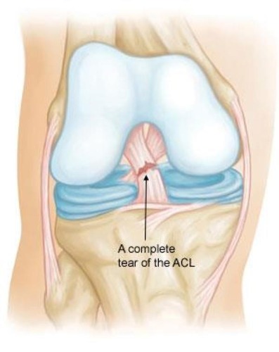 <p>Joins a bone to bone and usually tear at the ends. (sprain)</p>