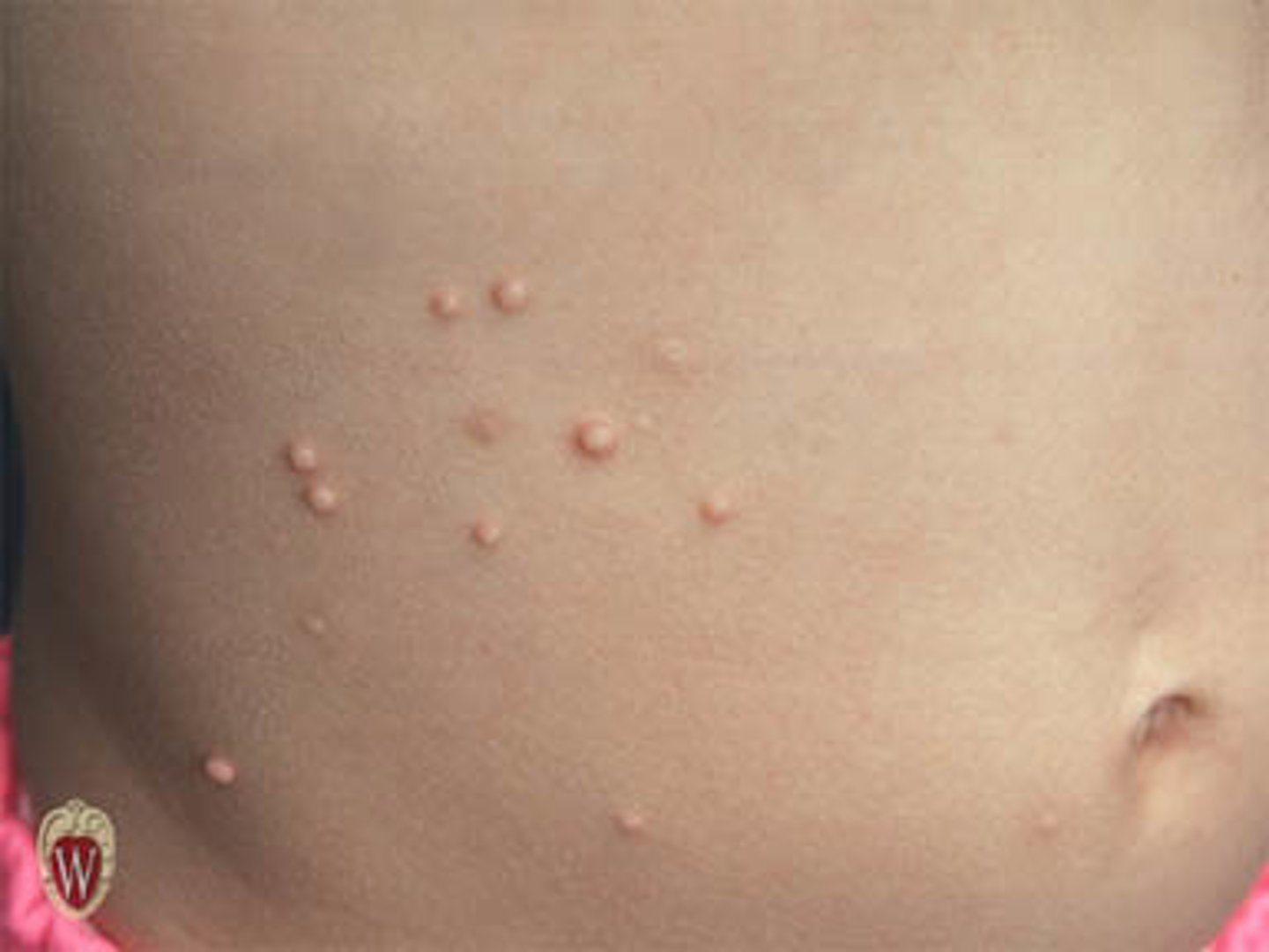 <p>Elevated, firm, circumscribed area</p><p>Usually less than 1 cm</p><p>Examples include warts and elevated moles</p>