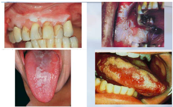 <p>Lesiones blanquecinas, planas, ligeramente elevadas, de aspecto áspero, que aparecen en mucosas (de la boca, del glande, de la vagina); pueden ser precancerosas, infecciosas o por efectos adversos.</p><p>Pueden ser dolorosas o no dolorosas.</p>