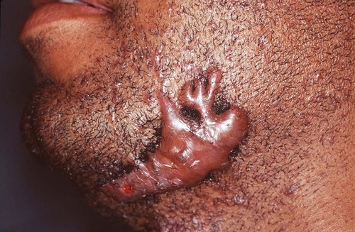 <p>Keloids (secondary lesion)</p>