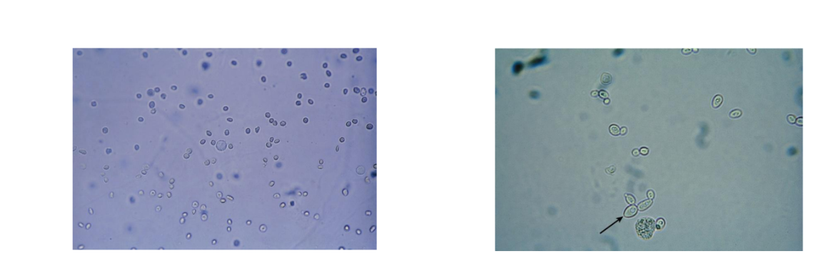<p><span>Smooth, nonnucleated, biconcave disks ~7 µm</span></p><p><span>Crenated in hypersthenuric urine</span></p><p><span>Ghost cells in hyposthenuric urine</span></p><p><span>Identify using high power</span></p>