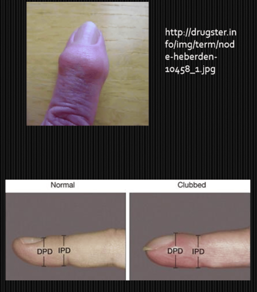 <p>Haygarth's nodes = dilated inflam joints on the proximal portion of finger in rheumatoid arthritis</p><p>Heberden's (distal) and Bouchard's (proximal) nodes = dilated non-inflam joints on the distal portion of finger in osteoarthritis</p><p>clubbing = angle between nail and finger is lost (floating fingernail) in CV disesae, thyrotoxicosis, hepatic cirrhosis</p>