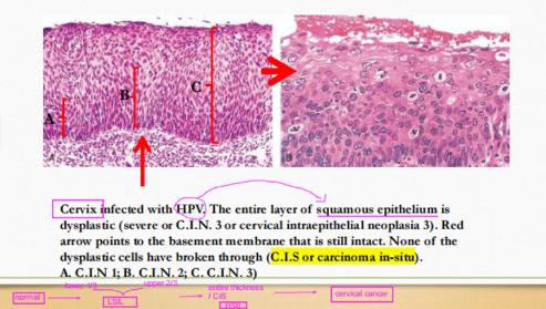 <p><span>carcinoma-in-situ</span></p>