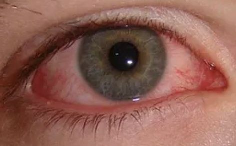 <p>Abnormalities of the External Eye</p><ul><li><p>Generalized inflammation of the conjunctiva</p></li><li><p>Commonly known as pink eye</p></li></ul><p></p>
