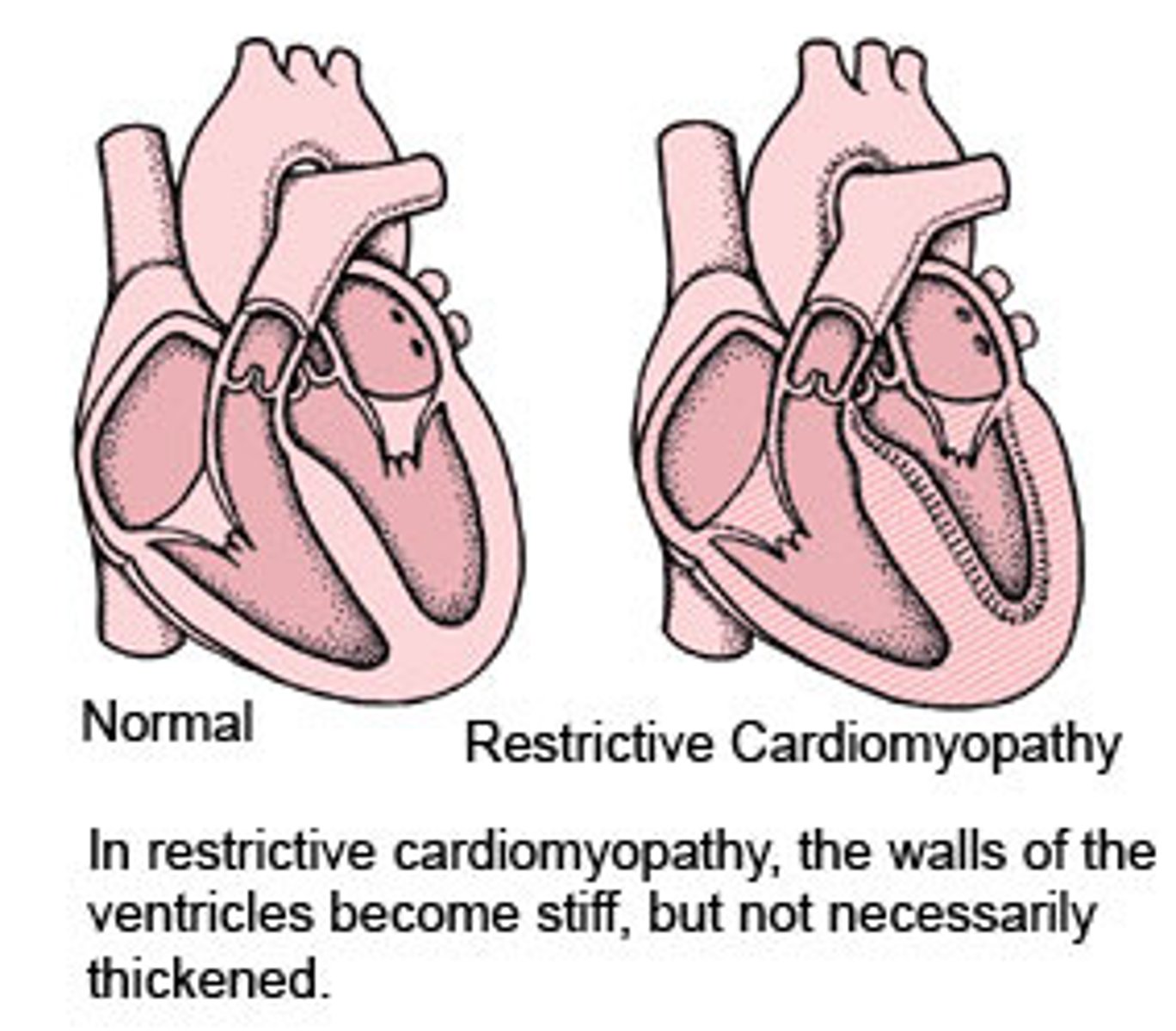 <p>restrictive cardiomyopathy</p>