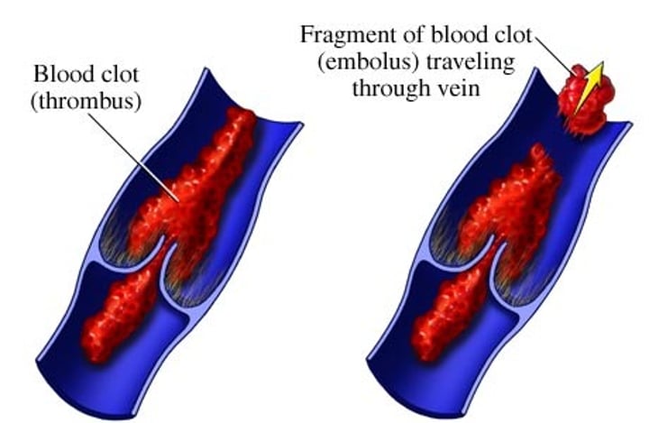 <p>aggregation of fibrin, platelets, and erythrocytes in an intact artery or vein</p>