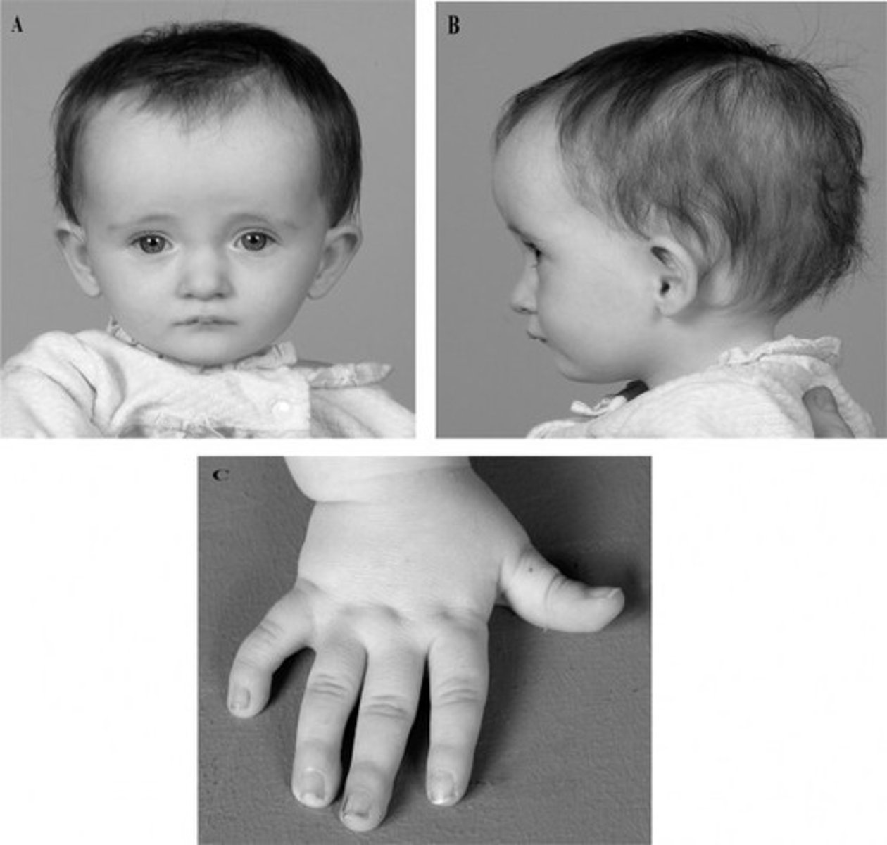 <p>Unknown etiology</p><p>Low birth weight, dwarfism, asymmetry of arms or legs, large head, craniofacial disproportion, mandibular hypoplasia, high, narrow palate, microdontia</p><p>Hypernasality, infant feeding problems, artic disorders, expressive and receptive language disorders, abnormally high-pitched voice</p>