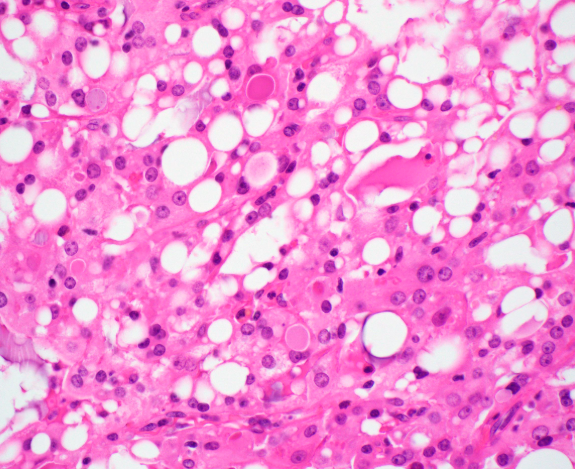 <p>Home de 40 ans, lésion parotide </p><p>1) Diagnostic</p><p>2) épidémio (âge, localisation) </p><p>3) Histo</p><p>4) IHC</p><p>5) moléculaire </p>