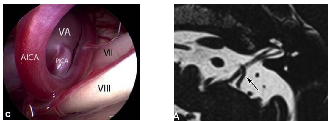 <ul><li><p>Klinische stoornis die veroorzaakt wordt door irritatie van de vestibulaire zenuw en gekenmerkt wordt door korte, veelvoorkomendevertigoaanvallen en gecombineerde tekenen ten gevolgevan schadeaan de n. VIII (bv. gehoorverlies,...)</p><ul><li><p>druk op myelineschede van zenuw → beschadiging = overgevoeligheid van de zenuw → elke keer prikkeling zenuw = aanval (soms zo erg dat zenuw echt kapot is)</p></li></ul></li><li><p>Isolatie rond zenuw begint te destabiliseren en wordt overgevoelig</p></li></ul><p>= neurovasculaire compressie</p>