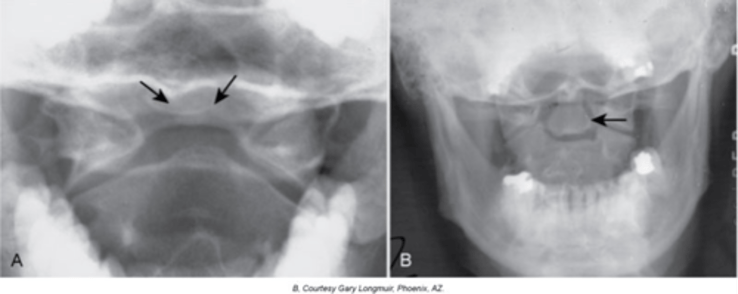 <p>With Os Odontoideum, hypertrophic changes of the _____ are very common and hint that it is a long lasting condition, not an acute traumatic fracture</p>