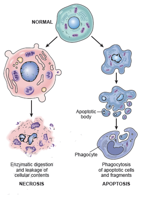 <p>Necrosis:</p><p><span>•</span><span style="font-family: &quot;Calibri Light&quot;;">Cells swell</span></p><p><span>•</span><span style="font-family: &quot;Calibri Light&quot;;">Nucleus swells</span></p><p><span>•</span><span style="font-family: &quot;Calibri Light&quot;;">Membrane dissolves</span></p><p><span>•</span><span style="font-family: &quot;Calibri Light&quot;;">Many cells involved</span></p><p><span>•</span><span style="font-family: &quot;Calibri Light&quot;;">Cells burst &amp; contents trigger an <u>inflammatory reaction</u></span></p><p></p><p>Apoptosis</p><p><span>•</span><span style="font-family: &quot;Calibri Light&quot;;">Cells shrink &amp; cytoskeleton collapses</span></p><p><span>•</span><span style="font-family: &quot;Calibri Light&quot;;">Nuclear chromatin condenses</span><span> </span><span style="font-family: &quot;Calibri Light&quot;;">(pyknosis &amp; karyorrhexis)</span></p><p><span>•</span><span style="font-family: &quot;Calibri Light&quot;;">Nuclear envelope disassembles</span></p><p><span>•</span><span style="font-family: &quot;Calibri Light&quot;;">Cell forms blebs into fragments (apoptotic bodies)</span></p><p><span>•</span><span style="font-family: &quot;Calibri Light&quot;;">Macrophages “eat” them</span></p><p><span style="font-family: &quot;Calibri Light&quot;;">—&gt; microscopic appearance: fragments of dark nucleus, few dead cells, little to no inflammation; </span><span>Because the cells are being eaten (phagocytized) and digested quickly, there usually few dead cells to be seen in a given area, even when large numbers of cells have died by apoptosis.</span></p><p></p>