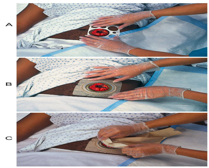 <p>faceplate / disk: attaches to abdomen. must be measured right size</p><p>pouch: collects effluent and gas. empty when <strong>1/3 - ½ full</strong></p><p>belt: can support pouch</p><p>clamp: at bottom of pouch to secure </p>