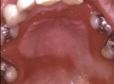 <p>What is denture stomatitis?</p>