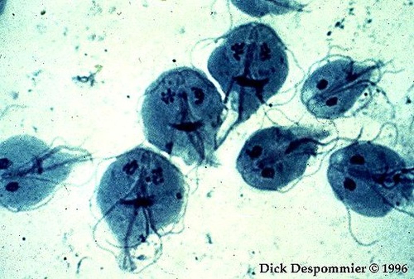<p>GIARDIASIS INTESTINAL ILLNESS --> attaches to walls of small intestine --> nutrient absorption issue --> diarrhea gas and cramps</p>