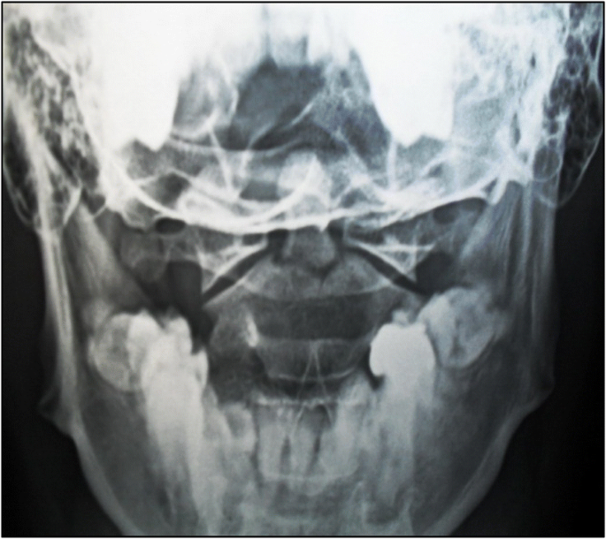 <p>odontoid fx</p>