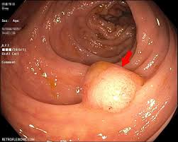 <p><span>A structure consisting of a rounded head attached to a surface by a stalk, mushroom-like. The typical skin polyps that develop ("skin tags") are benign.</span></p>