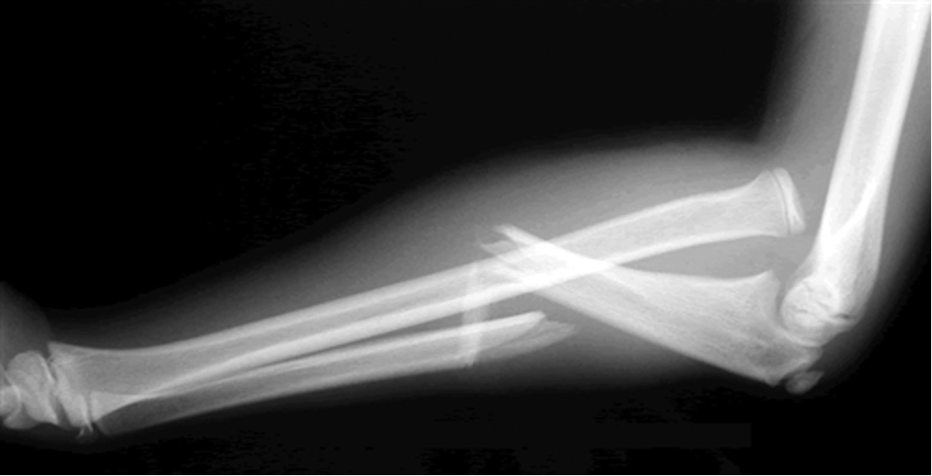 <p>fx of proximal ulna w/ dislocation of radial head </p>