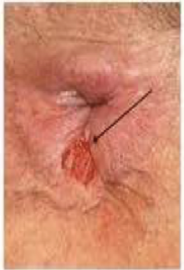 <p>24 y/o male patient to the clinic for a severe, sharp pain in the rectal area that started about a week ago. He also reports blood streaking in the stool and that pain increases on defecation. On physical exam you note cracks in the epithelium of the sphincter. What is your conservative treatment?</p>