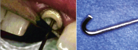 <p>Cast metal post and core restoration </p><p>Place wire in post space and fill down with interim resin&nbsp;</p>