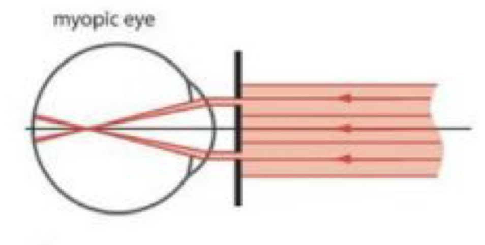 <p>What image will an myope produce as a result of the Scheiner principle?</p>