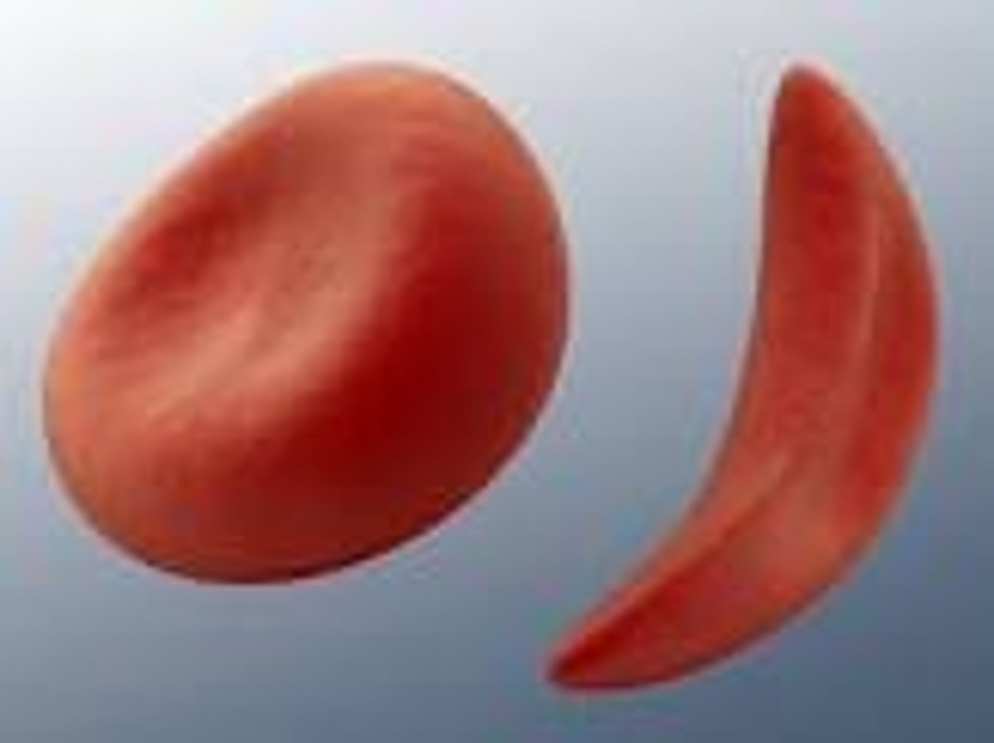 <p>Sickle cell disease is caused by a mutation where GAG is replaced by GTG, resulting in the substitution of Glu with Val.</p>