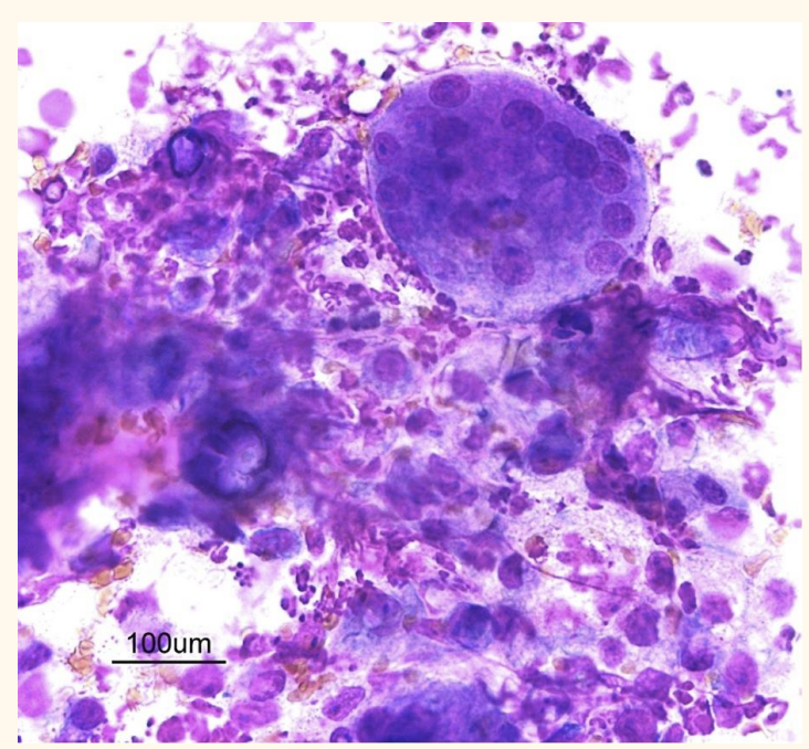 <p>Identify the cells on this aspirate</p>