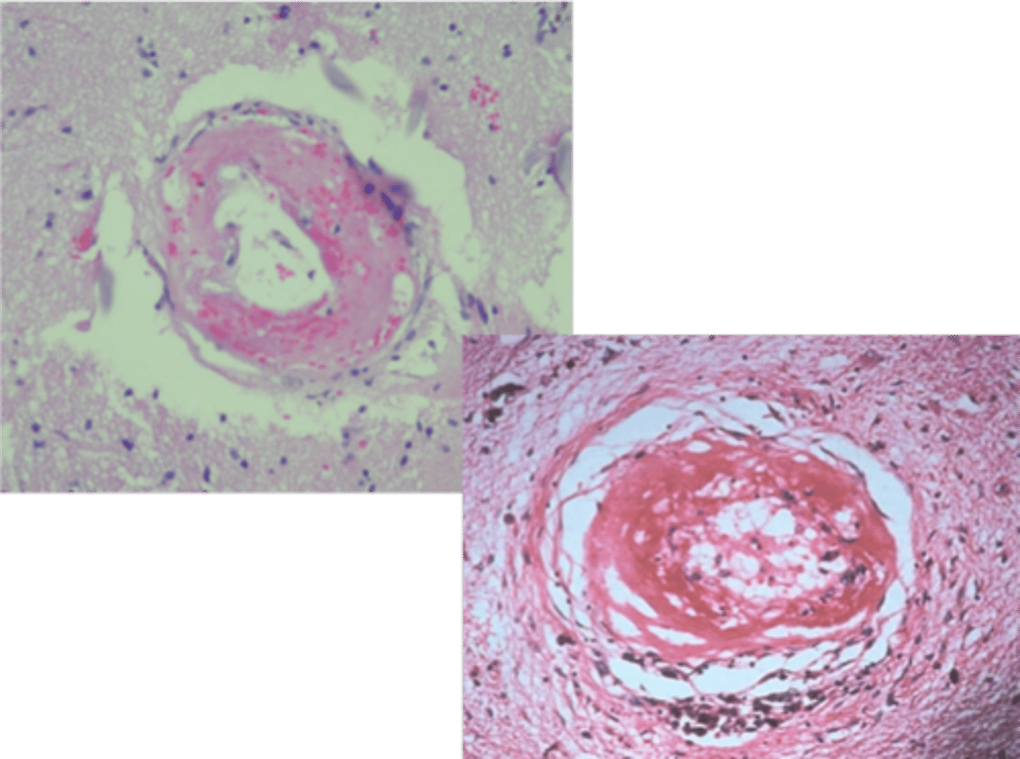 <p>clogging of the arteries</p>