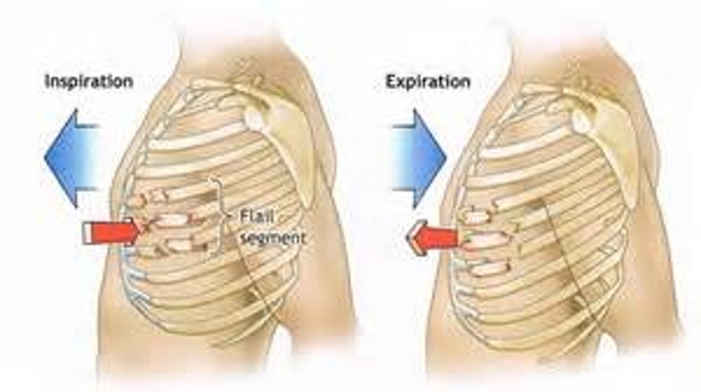 <p>fracture of two or more adjacent ribs in two or more places that allows for free movement of the fractured segment</p>