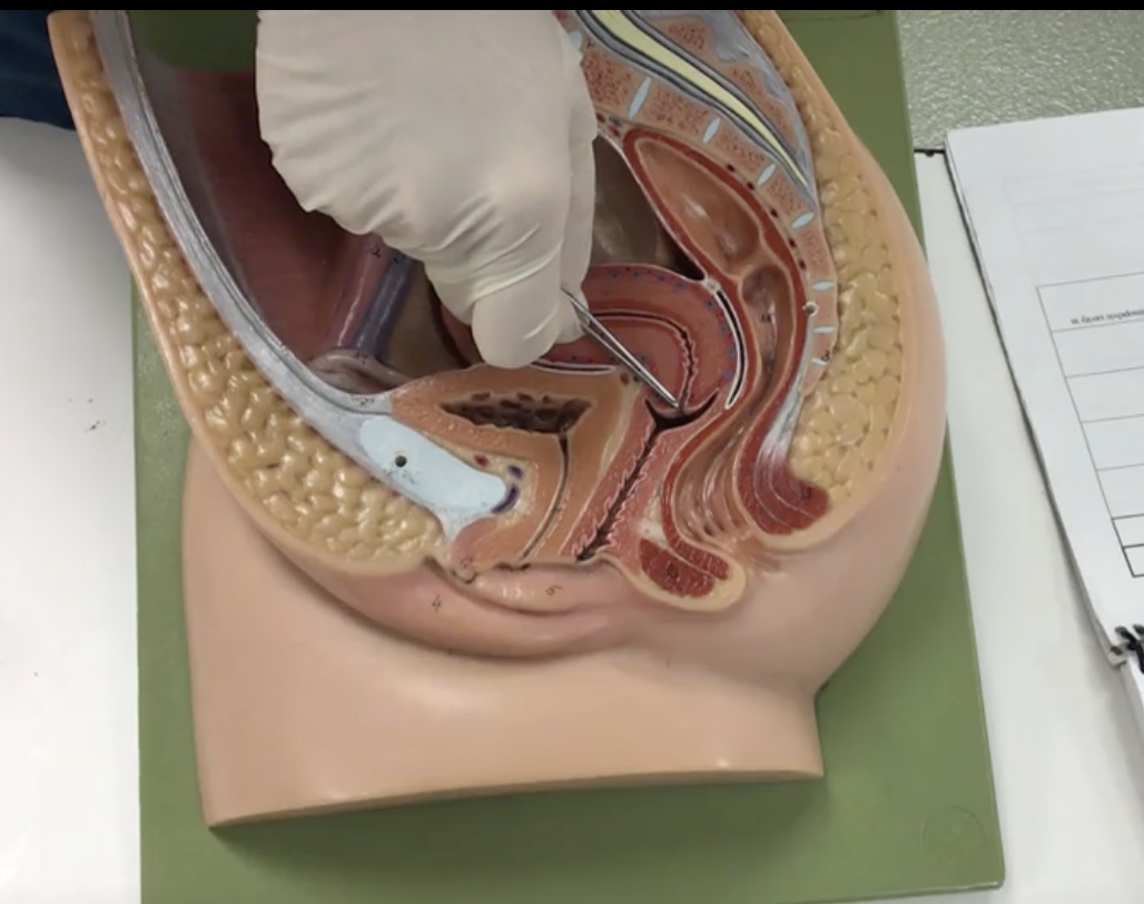 <p>Description: Narrow opening in cervix</p><p>Relationship: Junction of the cervix and vagina</p>