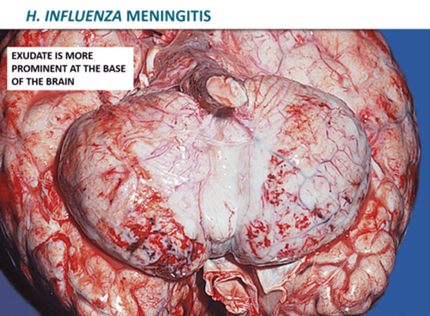 <p>1. Does NOT cause influenza (flu); Can enter the bloodstream</p><p>2. Pathogenicity due to capsule polysaccharides (antigen type b)</p><p>3. Occurs mostly in children (6 months to 4 years)</p><p>4. Accounts for 45% of bacterial meningitis cases; 6% mortality</p>