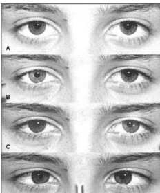 <p><strong>Lesion of the ciliary ganglion</strong></p><p>Pupil <u>doesnt </u>respond to illumination</p><p>Pupil <u>does</u> respond when converging</p><p><u>Parasympathetic deffect</u></p><p>-Benign</p><p>-Young females</p><p>-Diminished deep tendom reflexes</p>