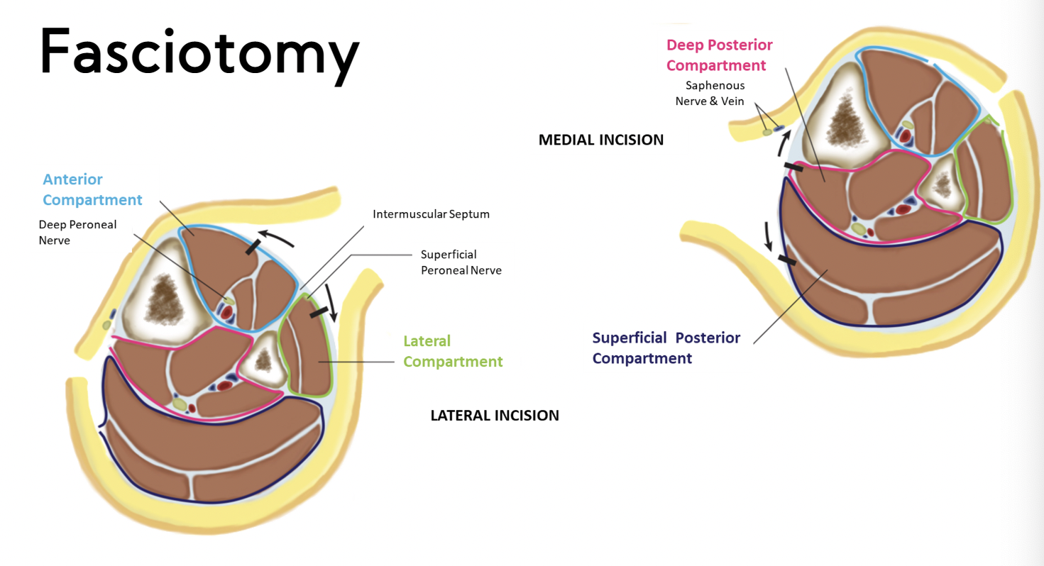 the term for the surgery that is performed to release the pressure inside the compartments 

\
diagram:

* shows lateral and medial incision of the compartments 
* cuts through the facia 
* release pressure building up in these areas