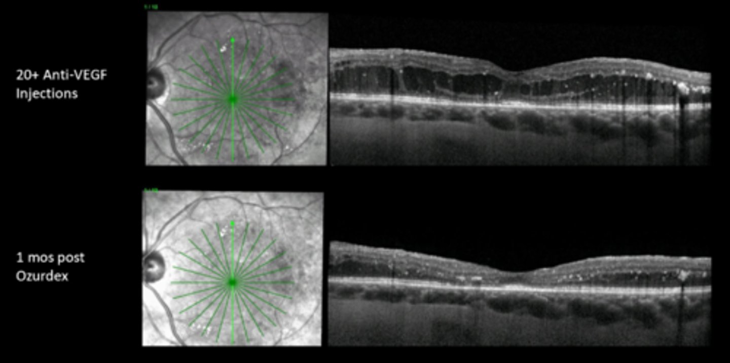 <p>What are some examples of intraocular steroids?</p>